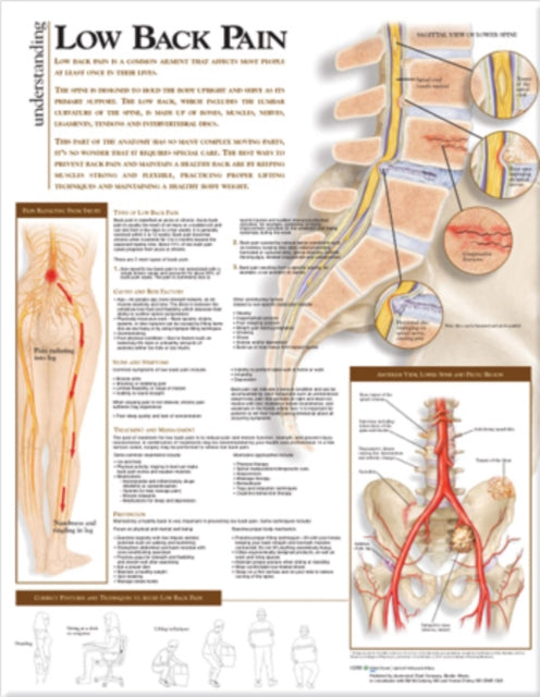 Understanding Low Back Pain Anatomical Chart-9780781782425